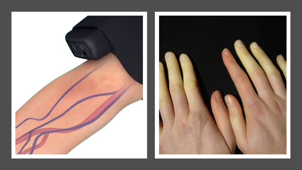 Raynaud's Disease is helped by Fist Assist Arm Compression Massager